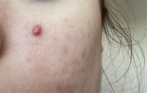 A pimple that won’t go away [Acne] : r/SkincareAddiction