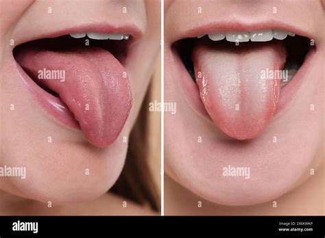 Woman showing her tongue before and after cleaning procedure, closeup ...
