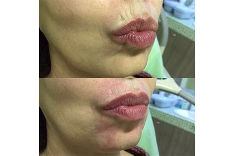 Кисетные морщины марионетки: как избавиться, убрать вокруг рта, над ...