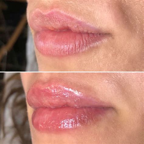Hyaluron Pen Lips | Lip fillers, Hyaluronic acid lips, Lips inspiration