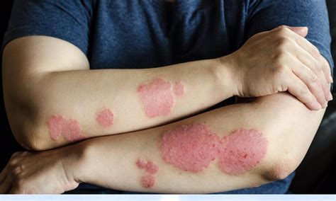 Contact Dermatitis: Identifying Triggers For Your Skin Rash And Redness ...