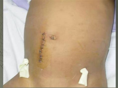 Apendicitis aguda en niños | PPT