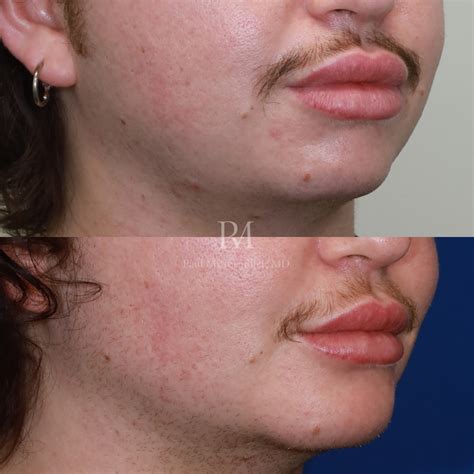 Facial Masculinization Surgery (FMS) with Custom Implant Before After Photos - #230203 - Paul ...
