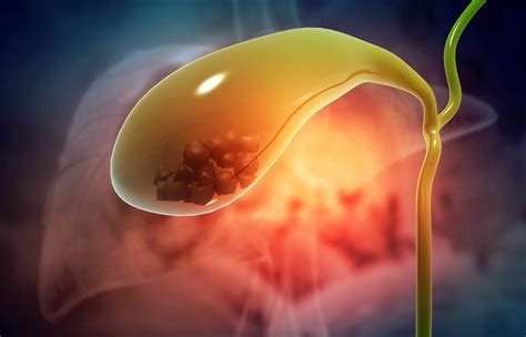 Can Gallbladder Stones Cause Cancer? | Roswell Park Comprehensive Cancer Center - Buffalo, NY