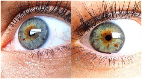 Complete Heterochromia