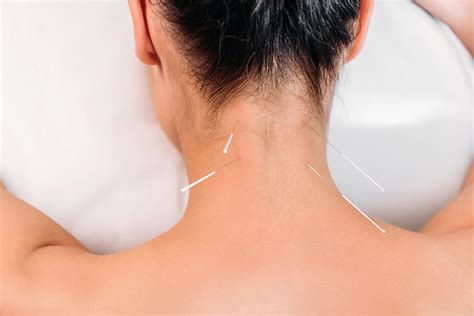 Get Pain Relief by Dry Needling - Best Massage Melbourne CBD