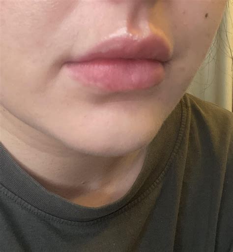 Creases after lip filler? : r/PlasticSurgery
