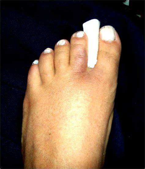 How to Treat an Injured or Broken Toe by Buddy-Taping - HealthProAdvice