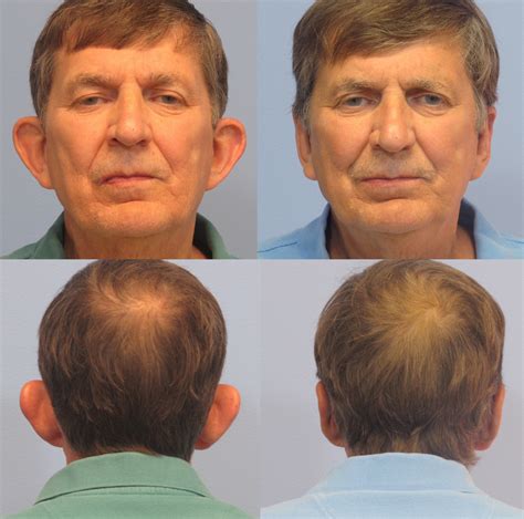 Cauliflower Ear Surgery