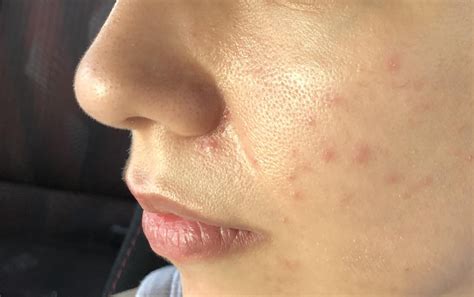 Anybody has skin issues like this? Suspecting gram-negative ...