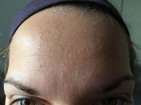 Tiny Dots On Forehead