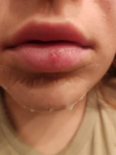 Could this be a cold sore on my lip? : r/DermatologyQuestions