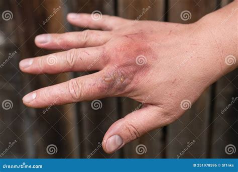 First Degree Burn On Hand How To Treat A Burn: First Aid