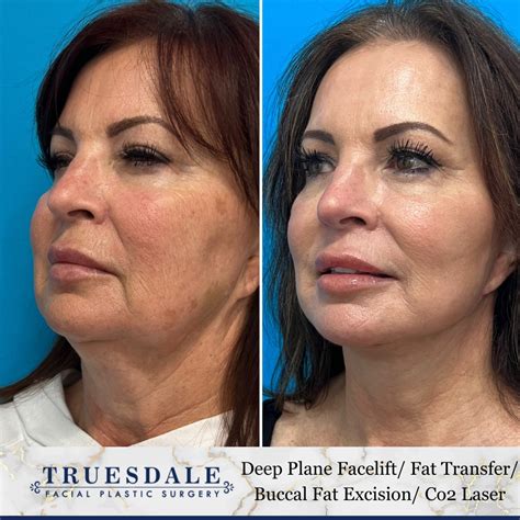 Facial Fat Transfer Gallery