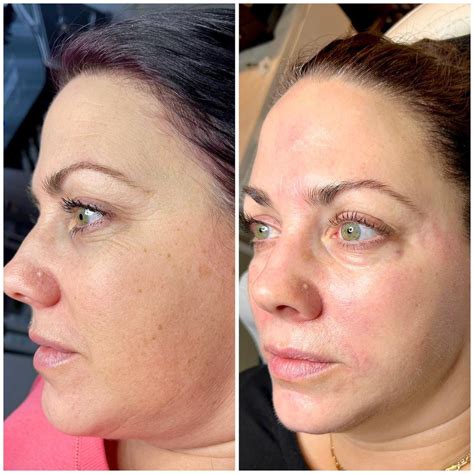 Nucleofill Before and After: Treatment Results | Fox Pharma