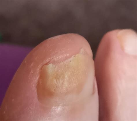 Onychomycosis (ICD-10. B35) - Online consultation AI dermatologist