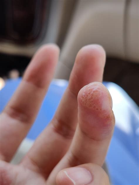 Peeling Blisters On Fingers _ Dyshidrotic eczema on the hands: Pictures ...