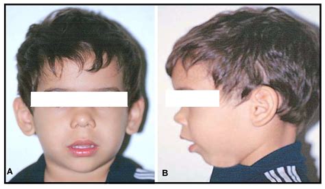 Adenoid Face Before And After