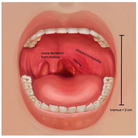 Diagnosis of Peritonsillar Abscess—A Prospective Study Comparing ...