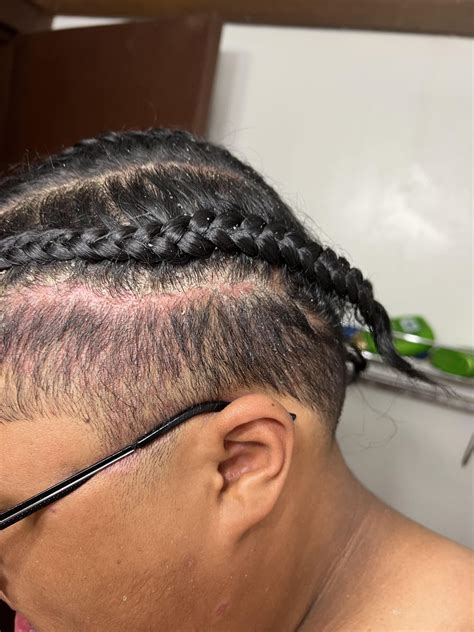 Help with Dandruff : r/BlackHair