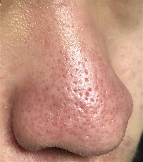 Large Pores On Nose And Cheeks