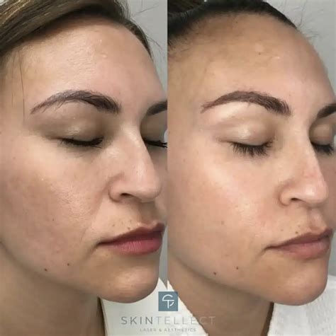 Fotona 4D Lift | Laser Skin Tightening | Skintellect