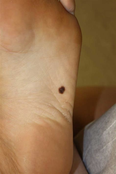 Melanoma Sole Of Foot
