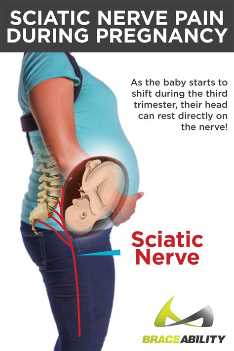 Sciatic Nerve Pain Pregnancy
