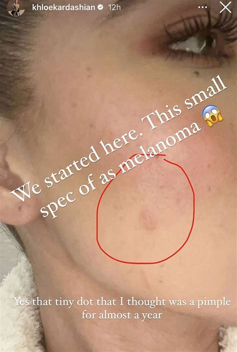 Khloe Kardashian shares before-and-after photos of melanoma battle - ABC News