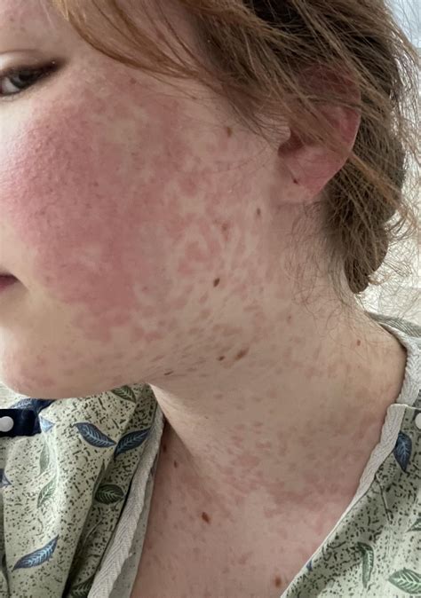 Update on “is this the rash?” : r/Lamotrigine