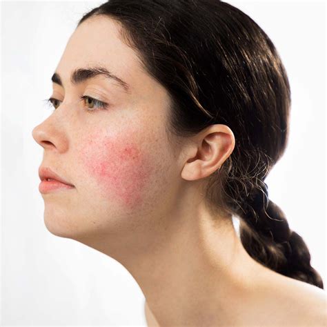 Decrease Skin Redness