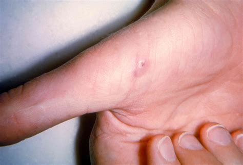 Rabies From a Cat Scratch: Is It Likely?