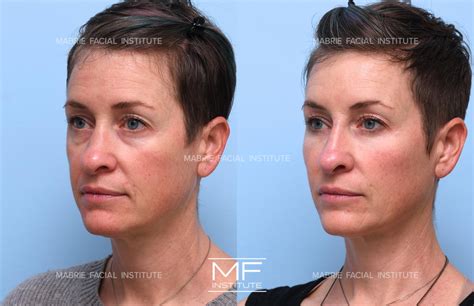 Nasolabial Fold Treatment With Filler & BOTOX® in the San Francisco Bay Area – Mabrie Facial ...