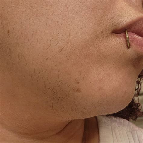 Pcos Chin Hair
