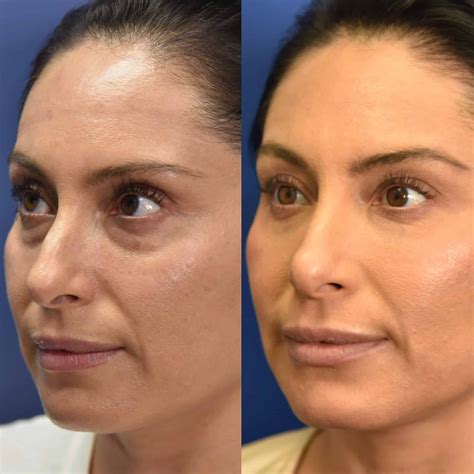 Results for Undereye Filler 😍 | Under eye fillers, Botox under eyes, Under eye bags
