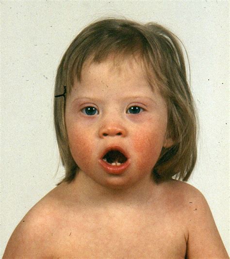 Image:Down Syndrome (Facial Features)-MSD Manual Professional Edition