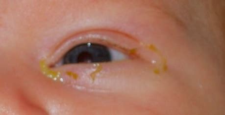 Baby's eyes-newborn examination | Key information for parents | Paedicare