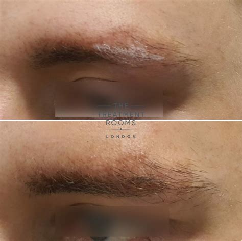 Eyebrow Scar Transplant | Treatment Rooms London