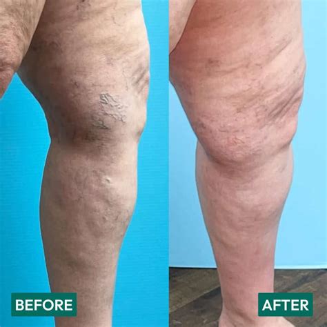 Can Varicose Veins Go Away