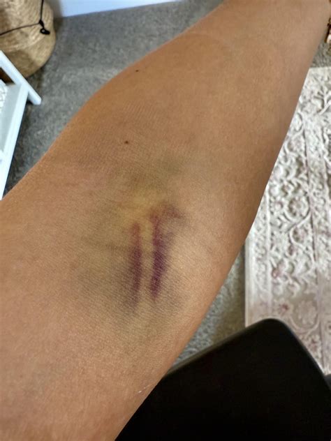 My bruise after blood draw is the shape of my vein - USLUCK