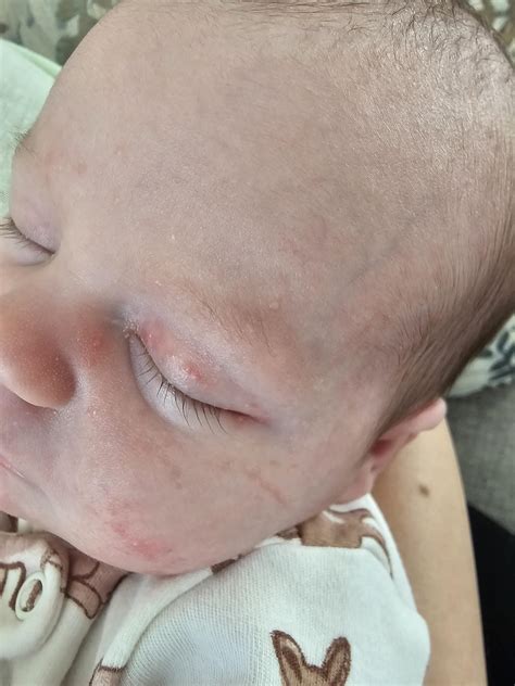 Baby Bumps On Face Baby Acne (Erythema Toxicum Neonatorum): Causes And