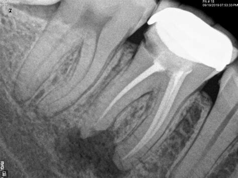 I am having an infection below the RCT teeth which causes prolonging pain. What is the best ...