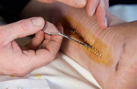 How To Remove A Suture Yourself Vs Professional Removal