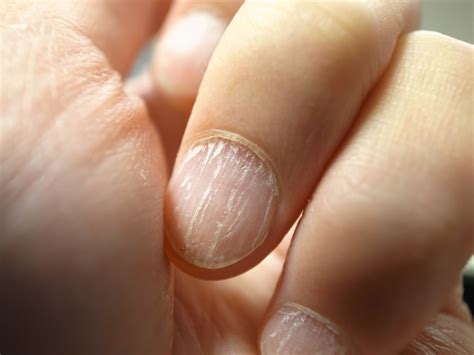 Cracked Nails - 7 Common Reasons And Ways To Repair Them - Nail Fungus ...