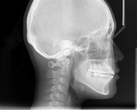 cephalometric radiograph - Google Search | ポスター