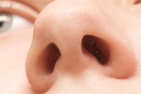 63/76? Vitamin Deficiency & Nasal Polyps Info - Liv Hospital