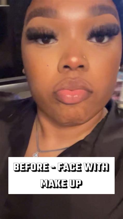 Jaw surgery ruined my face (before/after) : r/jawsurgery