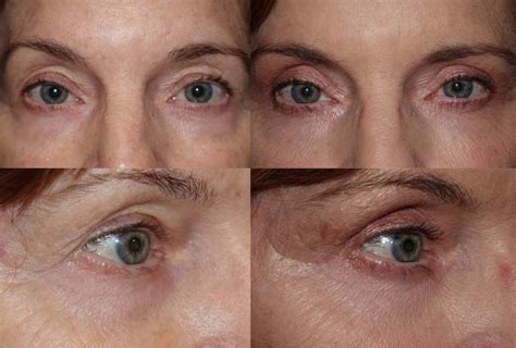 Eyelid Surgery
