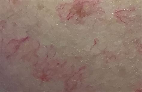 Spider Naevi In Cirrhosis