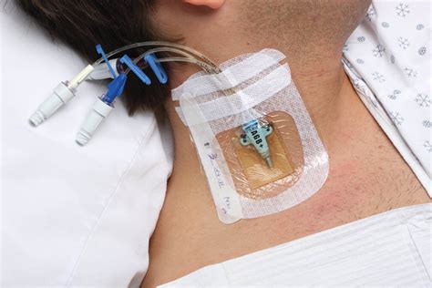 Types Of Vascular Access Devices at Walter Reece blog